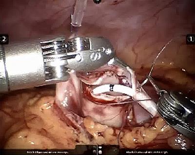 Searching for the Least Invasive Management of Pelvi-Ureteric Junction Obstruction in Children: A Critical Literature Review of Comparative Outcomes